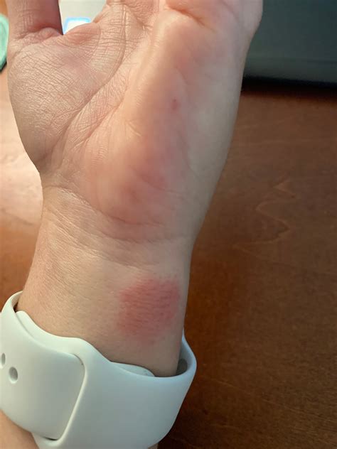 silicone watch band causing rash.